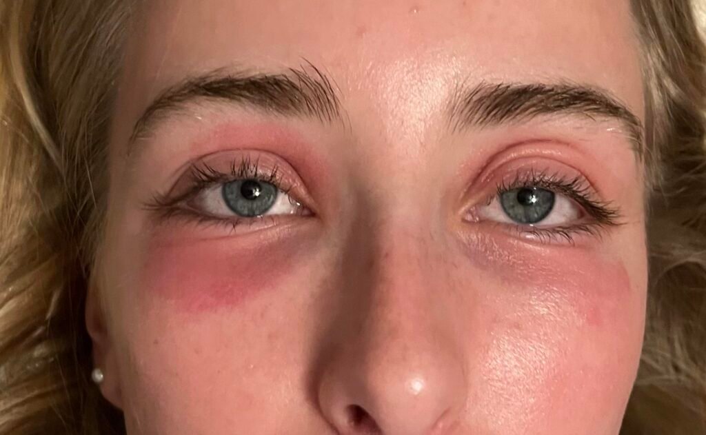 Rash around eyes