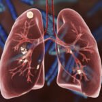 Lung Nodules (Pulmonary Nodules)